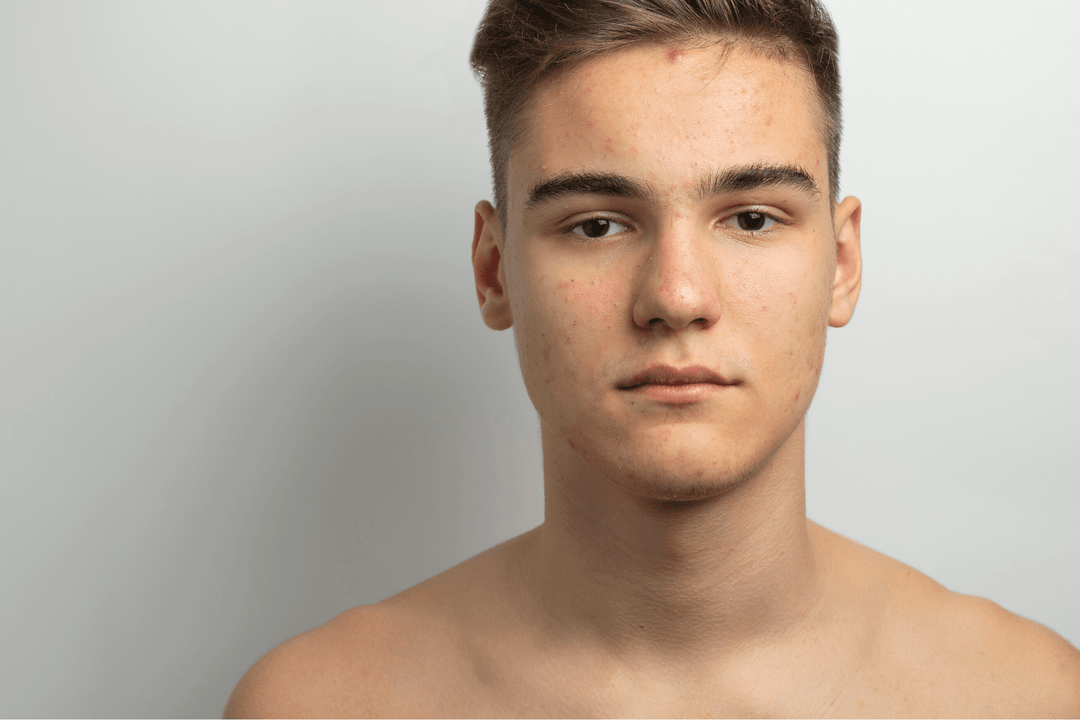 5 Game-Changing Things You Should Know About Acne