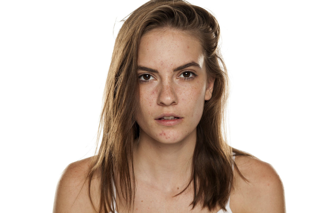 What Causes Adult Acne and How Can You Avoid It?