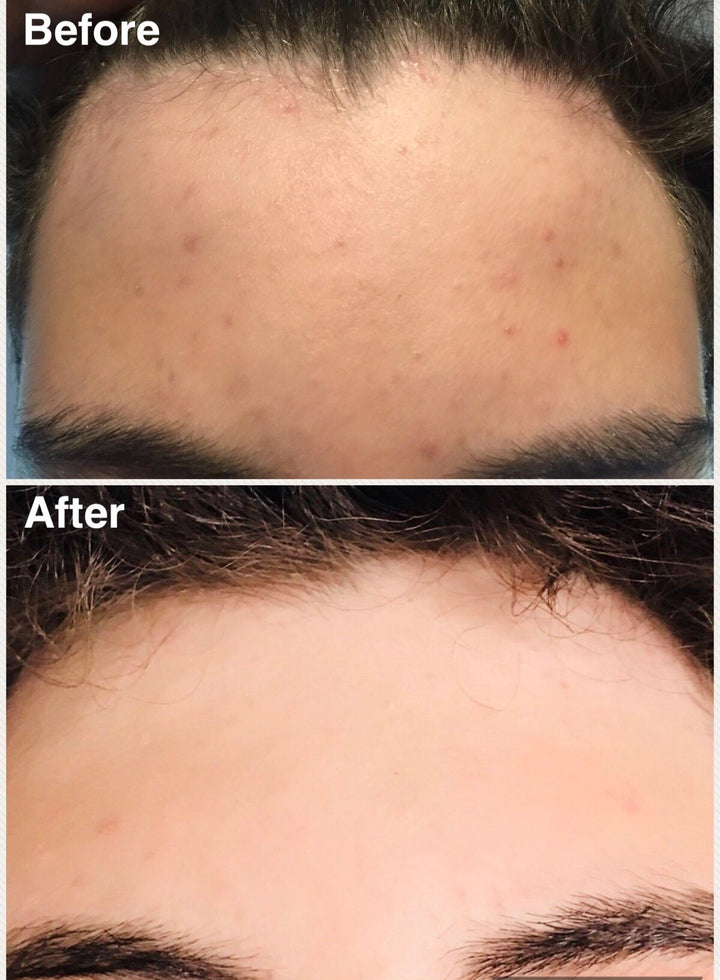 Teen Acne Shampoo + Conditioner Combo